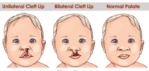 Before and after image showing successful cleft lip treatment in Navi Mumbai at Bodyskulpt Aesthetics.