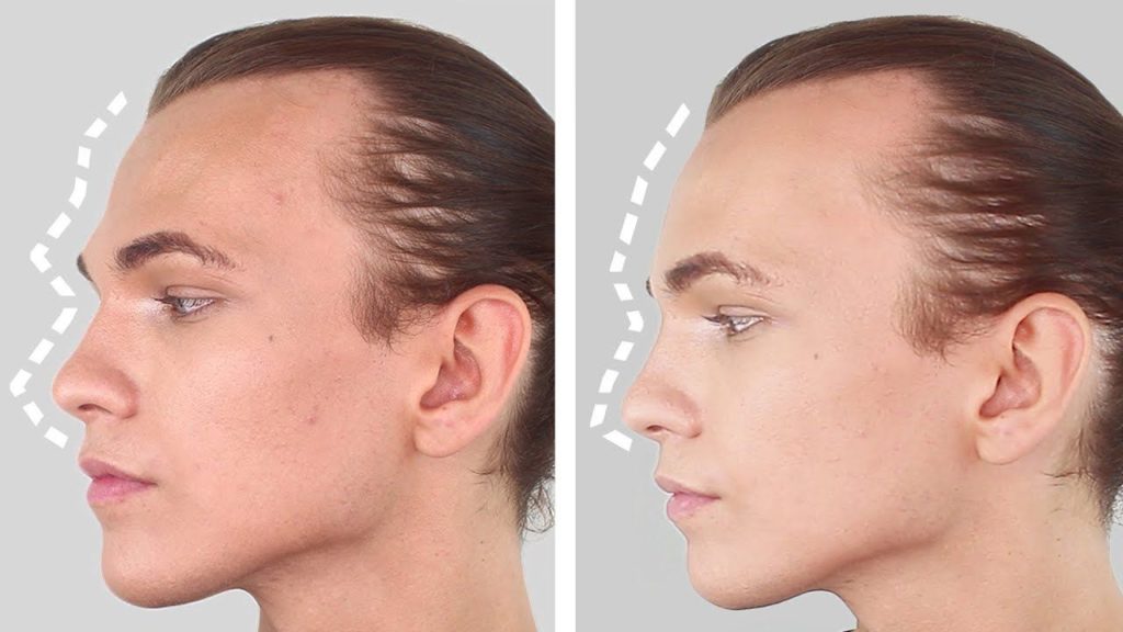 Before and after transformation of facial feminization surgery performed in India at Bodyskulpt Aesthetics.