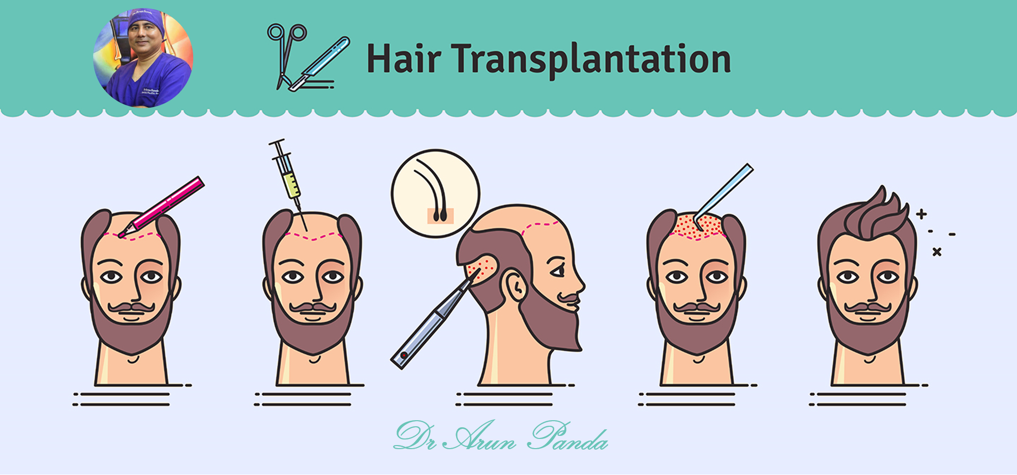 Read more about the article How is Hair Transplant performed in Navi Mumbai?