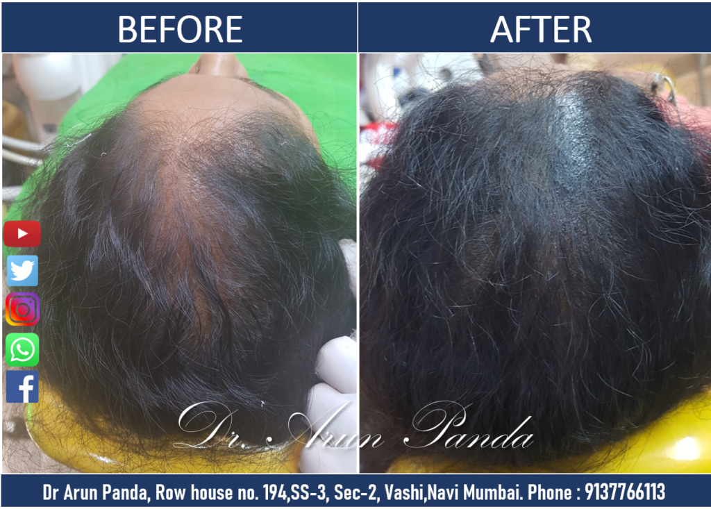 Female hair transplant services in Navi Mumbai for natural and effective hair restoration.