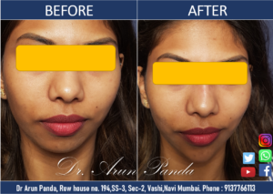 Read more about the article CHIN AND JAW LINE ENHANCEMENT TREATMENT IN NAVI MUMBAI