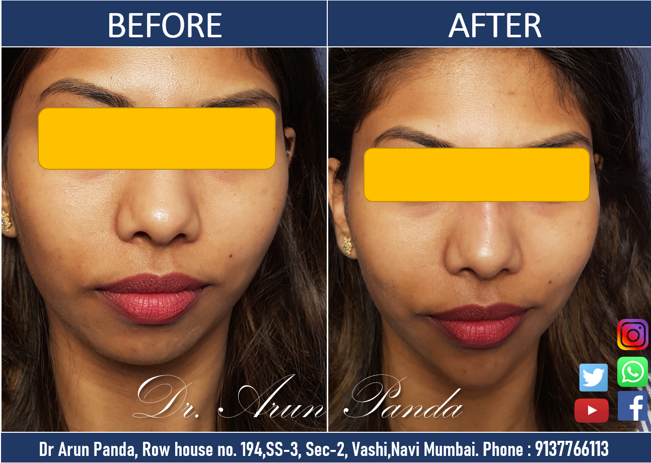 You are currently viewing CHIN AND JAW LINE ENHANCEMENT TREATMENT IN NAVI MUMBAI