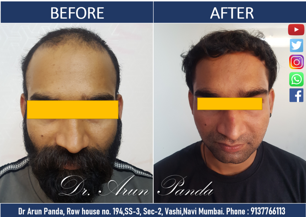 Professional hair transplant service available in Navi Mumbai for natural-looking results.