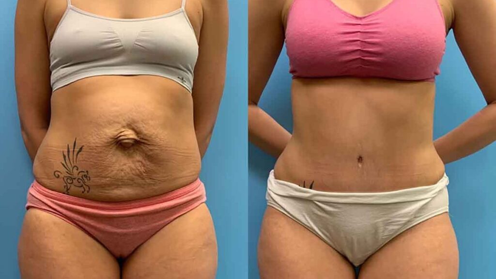 Real patient's results after abdominoplasty Tummy Tuck Surgery in Navi Mumbai —dramatic flattening of stubborn belly fat and skin.