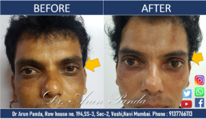 Read more about the article AESTHETIC TREATMENT PATIENT TESTIMONIAL SAYS DR PANDA IS THE BEST SKIN SPECIALIST IN NAVI MUMBAI