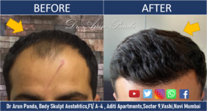 Read more about the article High-density Hair Transplantation Navi Mumbai