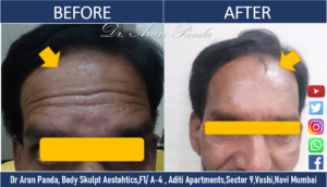 Read more about the article Botulinum toxin (Botox) for forehead wrinkles removal in Navi Mumbai