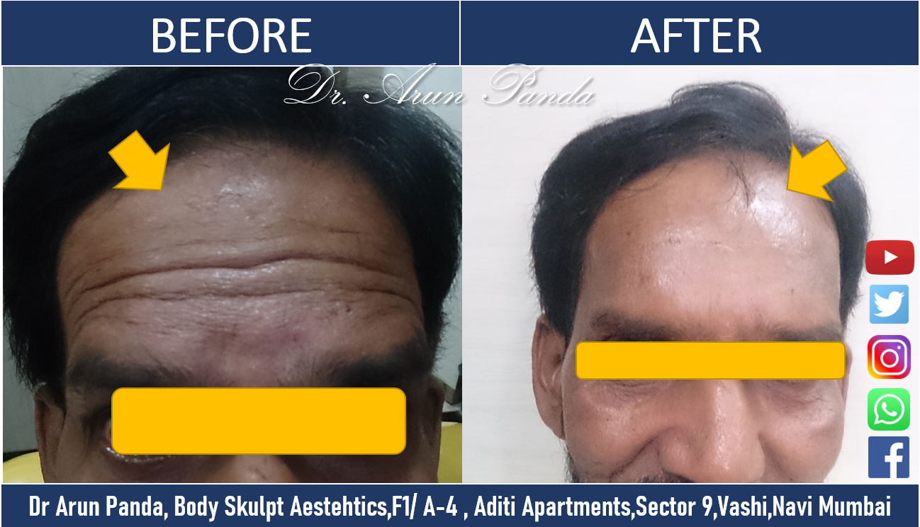 You are currently viewing Botulinum toxin (Botox) for forehead wrinkles removal in Navi Mumbai