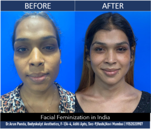 Read more about the article Cost of Facial Feminization Surgery in India | Price of Transgender Facial Surgery #ffs