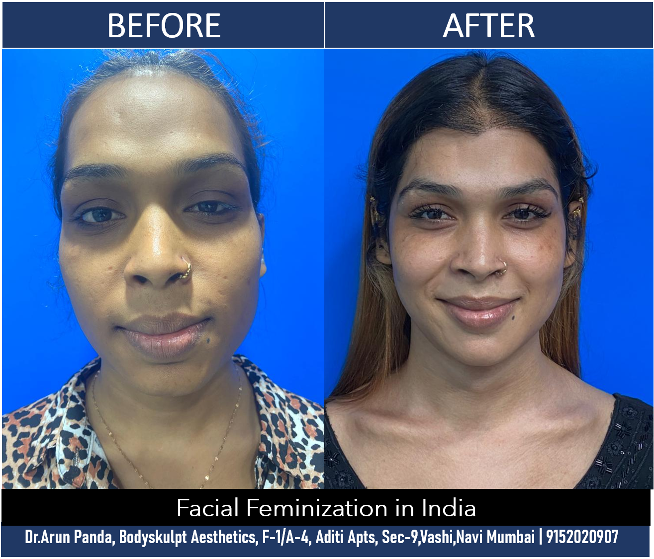 Facial Feminization Surgery in India results by Dr Arun Panda