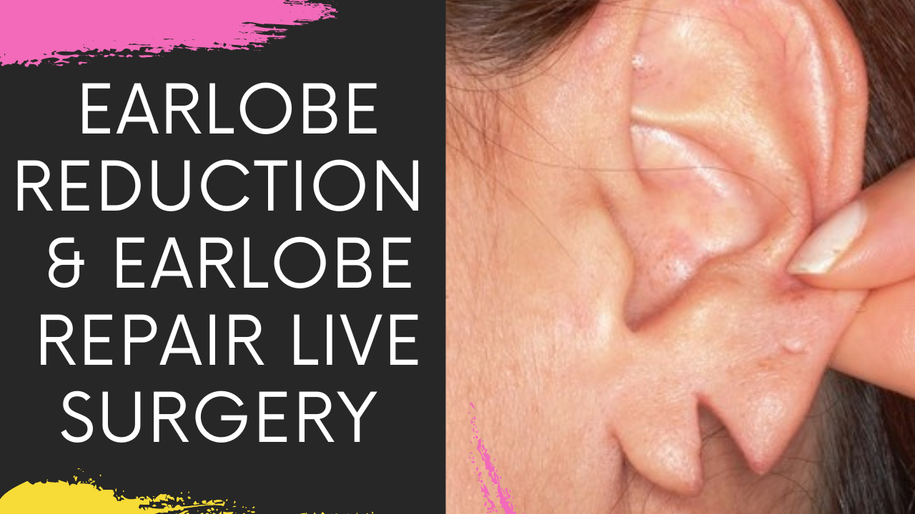 You are currently viewing Earlobe Repair & Reduction in Navi Mumbai