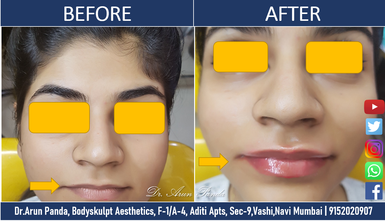 You are currently viewing Lip Reshaping Treatment in Navi Mumbai – Cost, Procedure, Side Effects,  Learn everything about them.