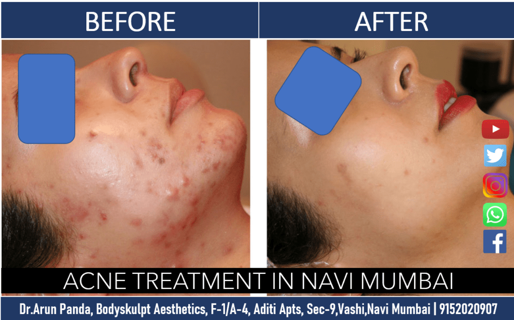 Before and after images of acne treatment results in Navi Mumbai at Bodyskulpt Aesthetics. Cost of Acne Treatment in Navi Mumbai.
