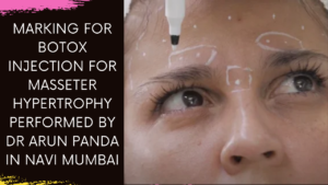 Read more about the article Mastering Masseter Hypertrophy: Botox Injection by Dr. Arun Panda in Navi Mumbai