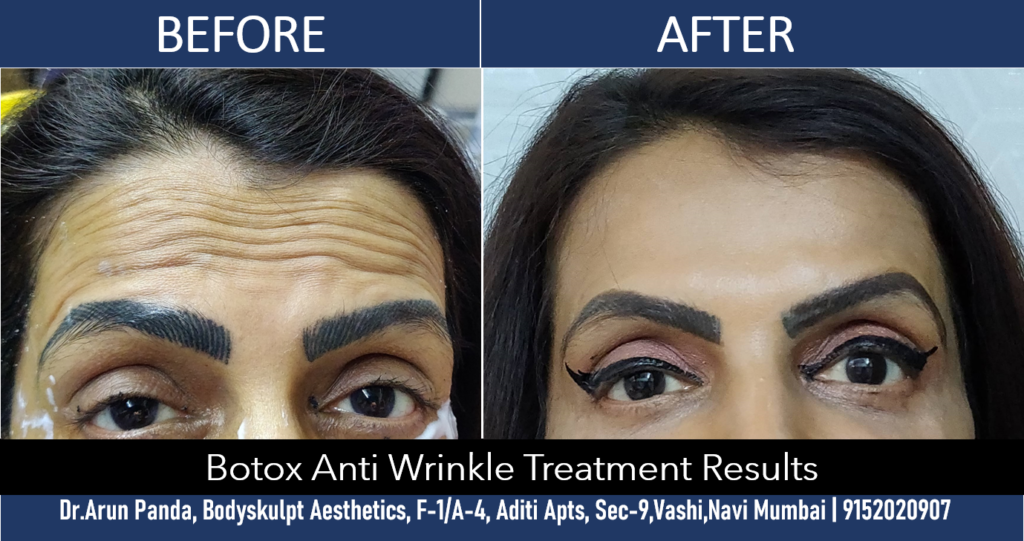 Before and after results of Botox wrinkle removal treatment in Navi Mumbai.