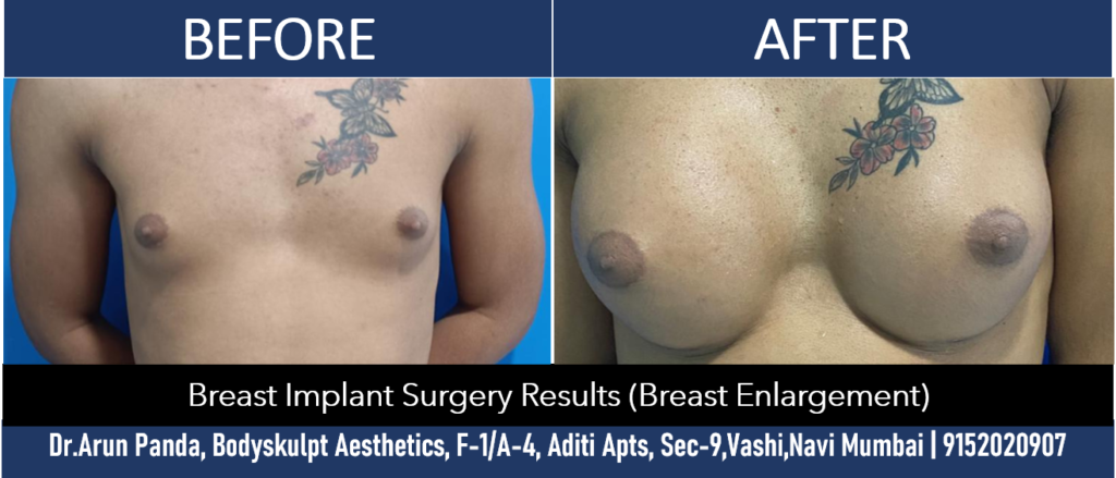 Before and after results of breast implant surgery in Navi Mumbai.
