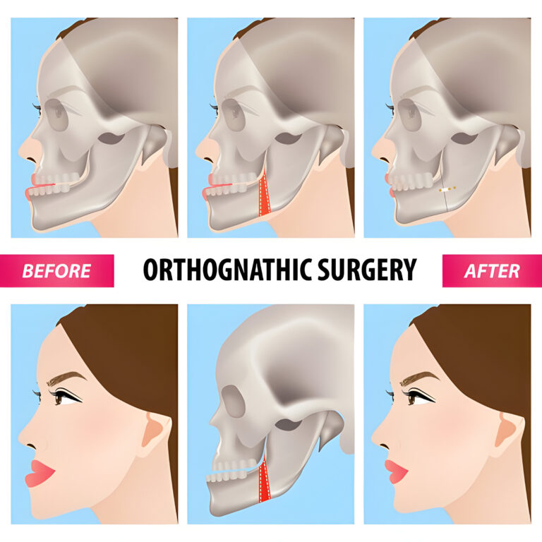 Cost of Orthognathic Surgery / Jaw Surgery in Mumbai, India