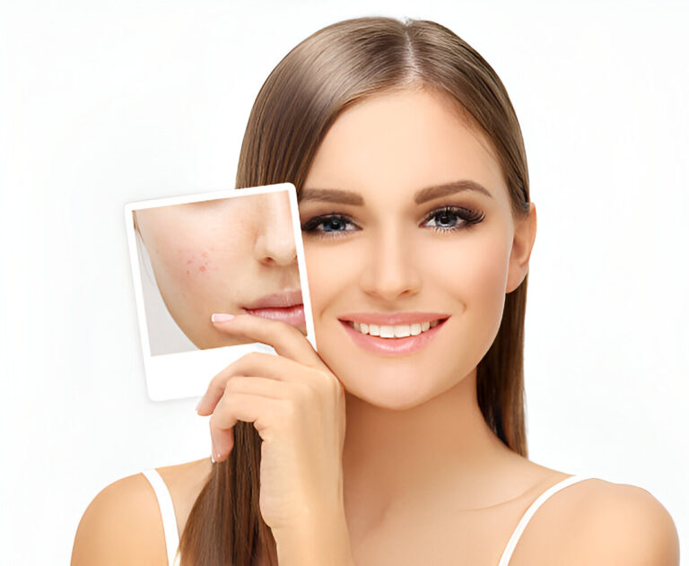 Effective acne and scar treatment in Navi Mumbai at Bodyskulpt Aesthetics for clear, smooth skin.