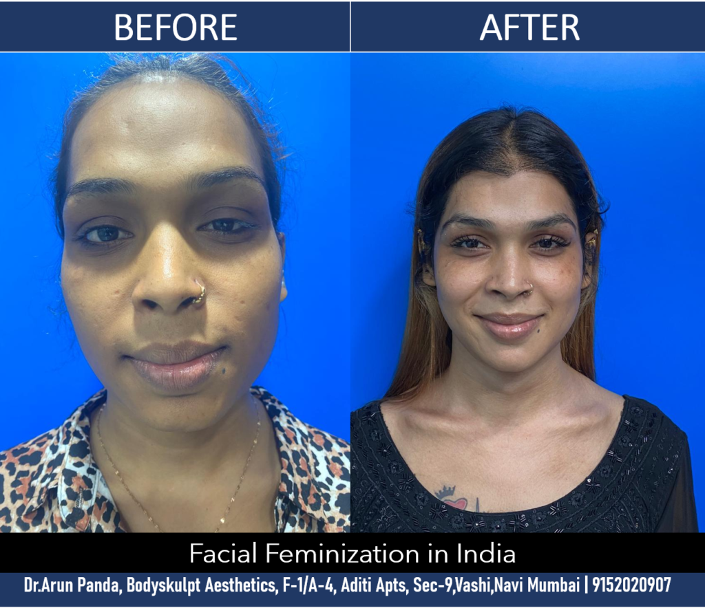 Facial Feminization Surgery in India results by Dr Arun Panda